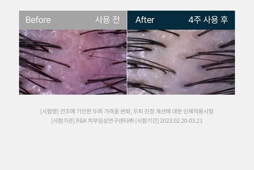 [단독2입기획]솔랩 전문가 처방급 탈모/두피 영양 앰플 40ml+40ml 상세페이지 23